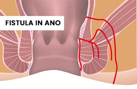 Fistula in ano Surgery
